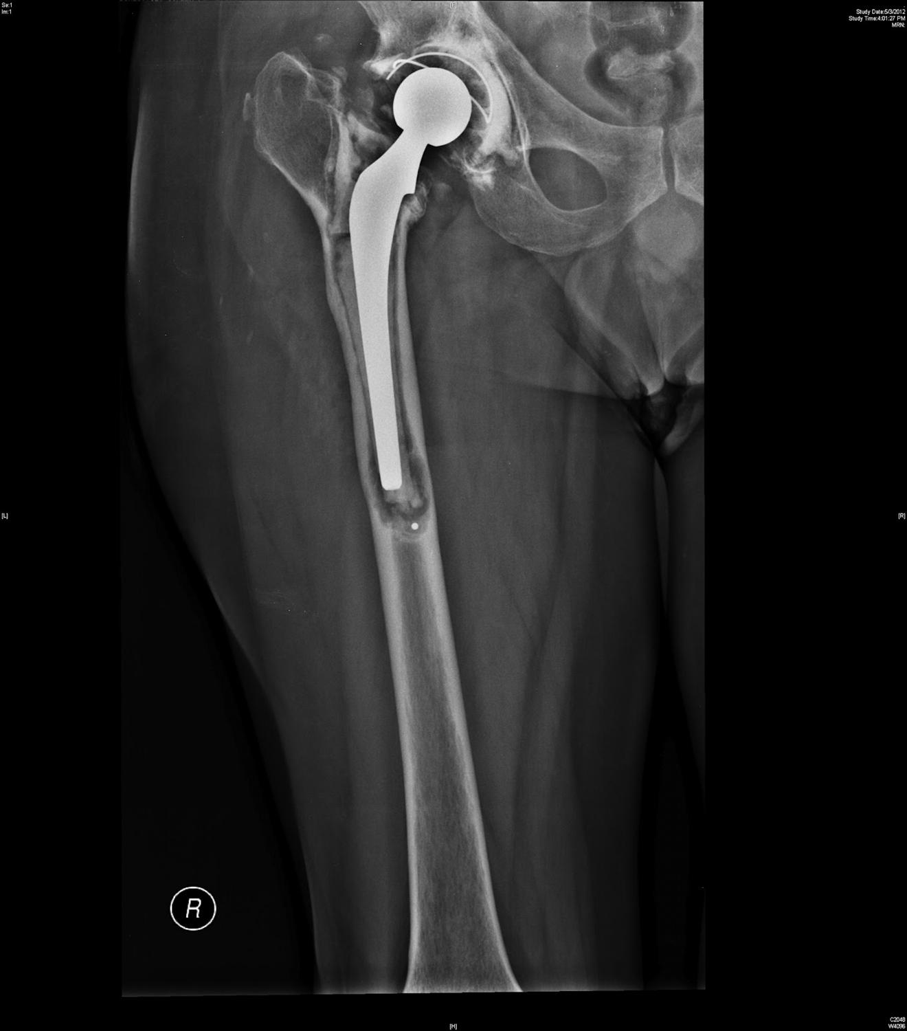 orthobullets-on-twitter-indications-for-surgery-for-periprosthetic
