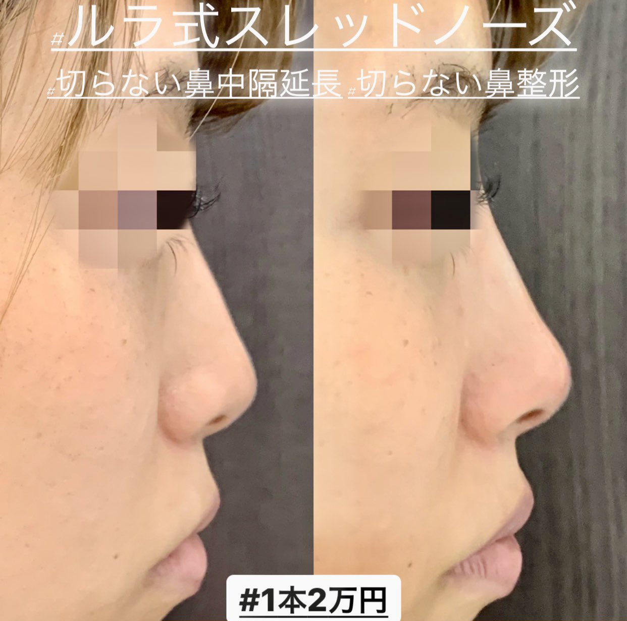 切らない鼻整形 Twitter Search Twitter