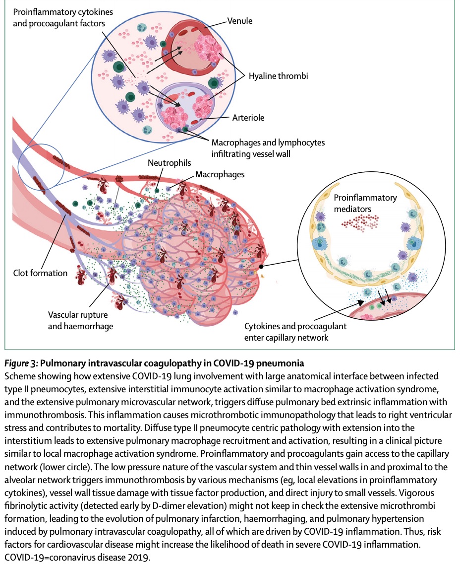 MNPs and are present in inflamed tissue such as the lungs, heart, and blood vessels. Here is a recent example in  @TheLancet, which describes immune mechanisms of pulmonary intravascular coagulopathy in COVID-19 pneumonia. (More on clotting later.) https://www.thelancet.com/journals/lanrhe/article/PIIS2665-9913(20)30121-1/fulltext#.XrbEk9zQTsY.twitter