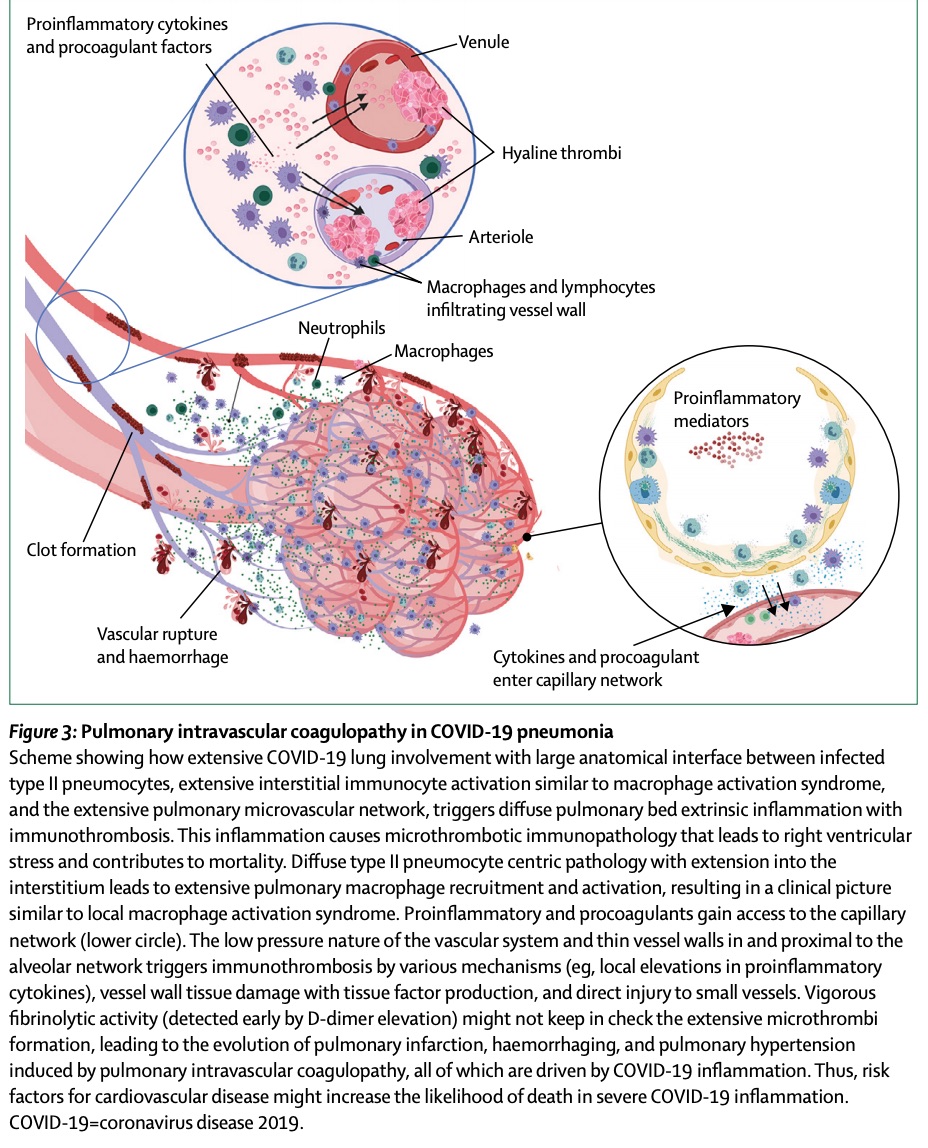 MNPs and are present in inflamed tissue such as the lungs, heart, and blood vessels. Here is a recent example in  @TheLancet, which describes immune mechanisms of pulmonary intravascular coagulopathy in COVID-19 pneumonia. (More on clotting later.) https://www.thelancet.com/journals/...