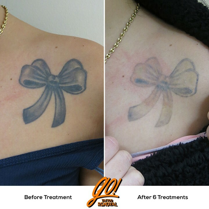Full and Half Sleeve Tattoo Removal  Removery
