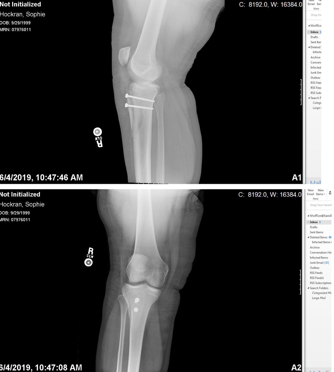 DocHawkDO's tweet photo. 1 year post op today. Blessed and humbled ❤️☺️ #ontwolegs https://t.co/TgEj5NoVsS