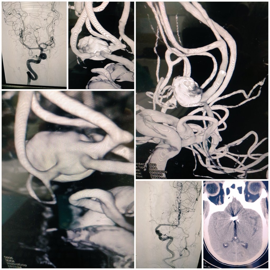 withoutscalpel's tweet photo. #wide neck acom aneurysm
#coiled #stented across acom
#neuroIR #NIMHANS https://t.co/CY7SWP8XDF