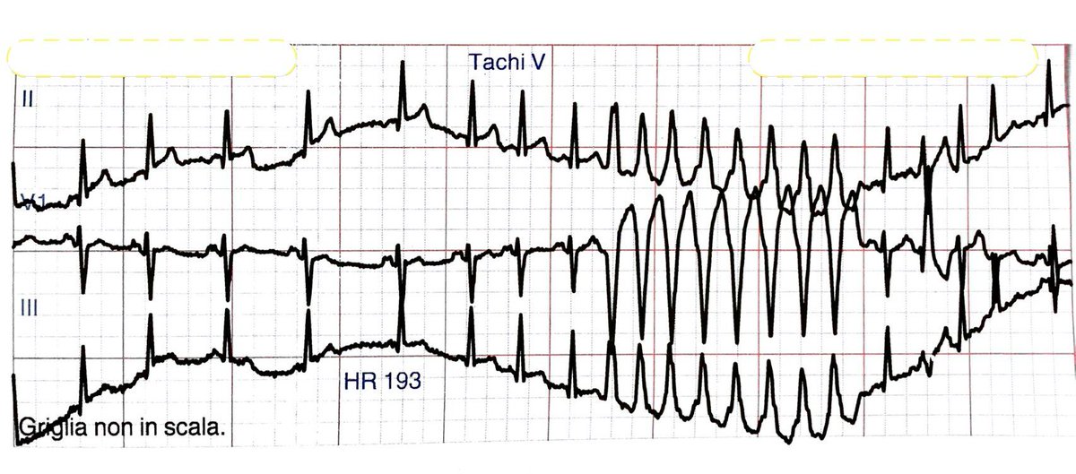 glumia's tweet photo. A 19-year-old man presented to the emergency department of my hospital after an episode of syncope. He experienced palpitations before and after the syncope. One month ago he was placed on long action flecainide for atrial premature complexes. Look at the scary ECGs😱 #FOAMed https://t.co/jJRpTpjahD