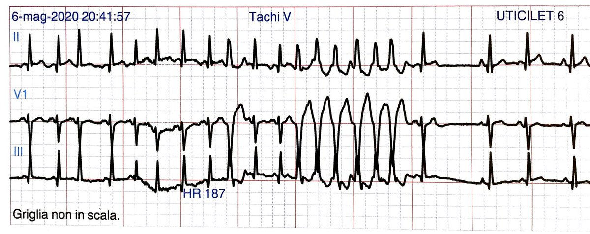 glumia's tweet photo. A 19-year-old man presented to the emergency department of my hospital after an episode of syncope. He experienced palpitations before and after the syncope. One month ago he was placed on long action flecainide for atrial premature complexes. Look at the scary ECGs😱 #FOAMed https://t.co/jJRpTpjahD