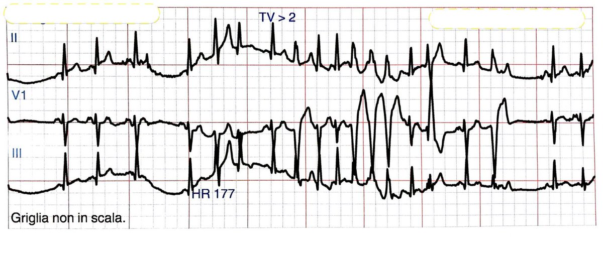 glumia's tweet photo. A 19-year-old man presented to the emergency department of my hospital after an episode of syncope. He experienced palpitations before and after the syncope. One month ago he was placed on long action flecainide for atrial premature complexes. Look at the scary ECGs😱 #FOAMed https://t.co/jJRpTpjahD