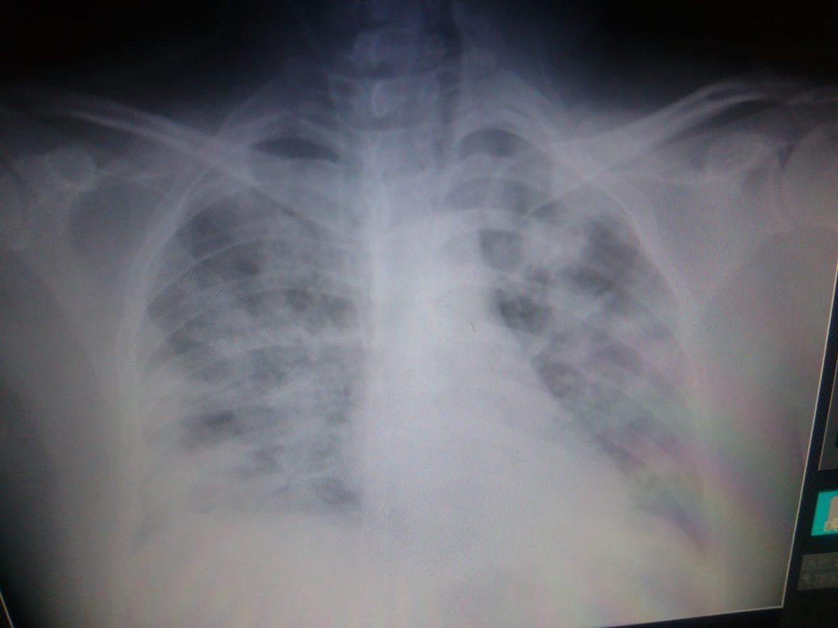 Chest-X ray w no pneumothorax. Pt did not improve w position. Fortunately intubation was successful and is now doing better. This was just ARDS that deteriorated quickly. I believe supine position precipitated deterioration. Could valsalva maneuver have played a role? 3/3
