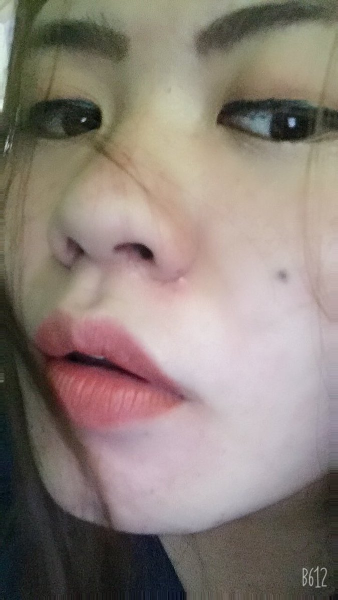 Orawee92893594's tweet photo. เมื่อสิวมาอาการก้อจะตามมา https://t.co/cXdkYagKZs
