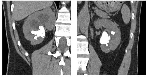 Our first experience of bilateral single session PCNL in Portsmouth Hospitals. It is feasible and safe if performed in selected patients. 
Treating the contra-lateral kidney only attempted when the first PCNL has been performed quickly and easily without complication.