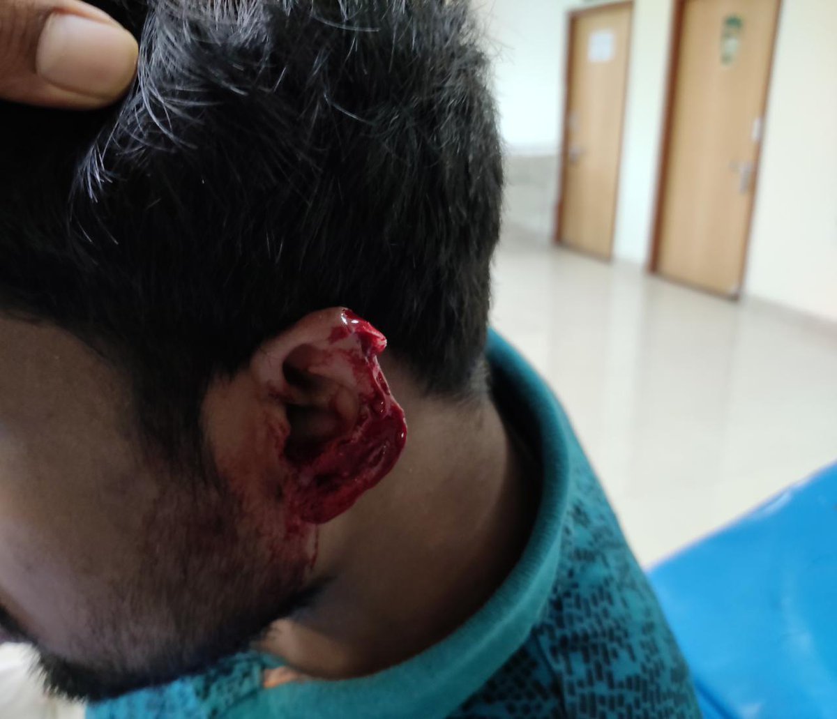 IndiaSacred's tweet photo. A brutal attack on duty doctor DR SHAKIL KHAN of MKCG MCH BERHAMPUR. A MALE attendant of a patient BITE OFF his EAR when the dr stopped him from entering  LABOR ROOM n attacked other drs
Our demand is to book the culprit under NSA ACT as promised.@CMO_Odisha @PMOIndia @sp_ganjam https://t.co/pTLCUVD4le