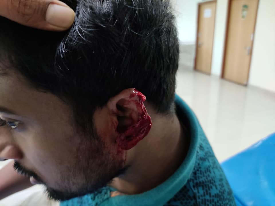 Ear of a doctor on duty bitten off by patient attendant when the doctor asked the attendant not to enter labour room and maintain social distancing at a Medical College in Behrampur, Odisha .  <a href="/AmitShah/">Amit Shah</a> <a href="/PIBHomeAffairs/">PIB - Ministry of Home Affairs</a> <a href="/DrSumitPeriwal/">Dr Sumit Periwal</a> Change.org/IndiaProtectDo… #IndiaProtectDoctors