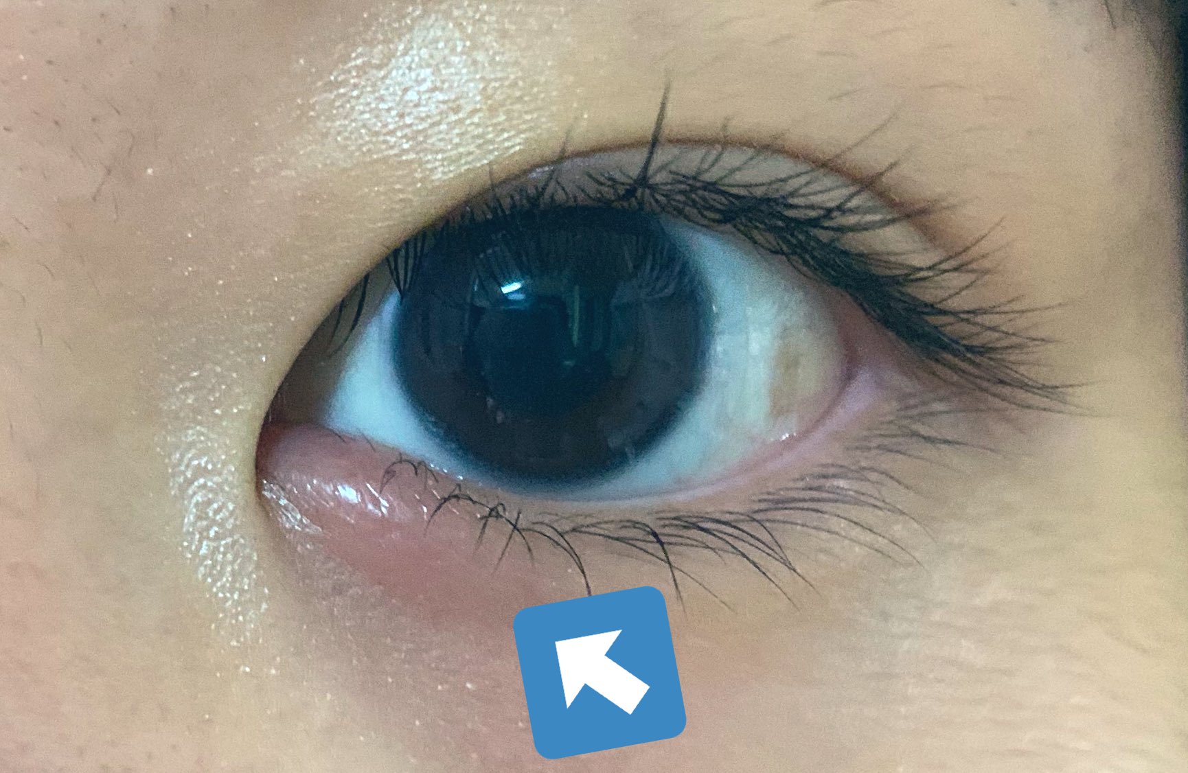 虚無森ホルン Web系修行中 Ar Twitter ねぇ目頭腫れてきたんだけどwwwwwまた眼帯ホルンになるの Wwwwwwもうやだ本当にwwwwww連鎖してんのか左頬の筋肉も痛い Www