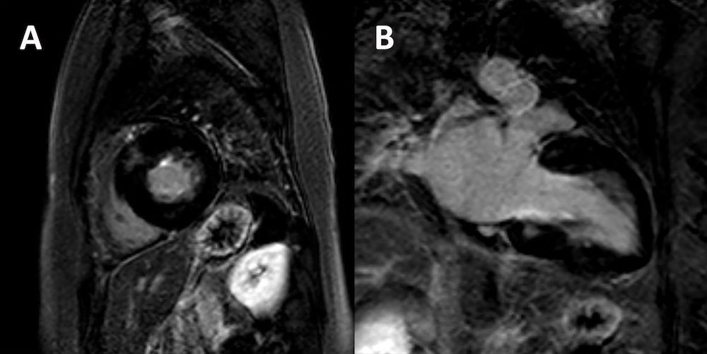 Aprendiendo a diferenciar las hipertrofias del miocardio en la práctica diaria buff.ly/30WmlmR
Repaso de la revisión publicada en RETICweb
#imagencardiaca #cardiologia