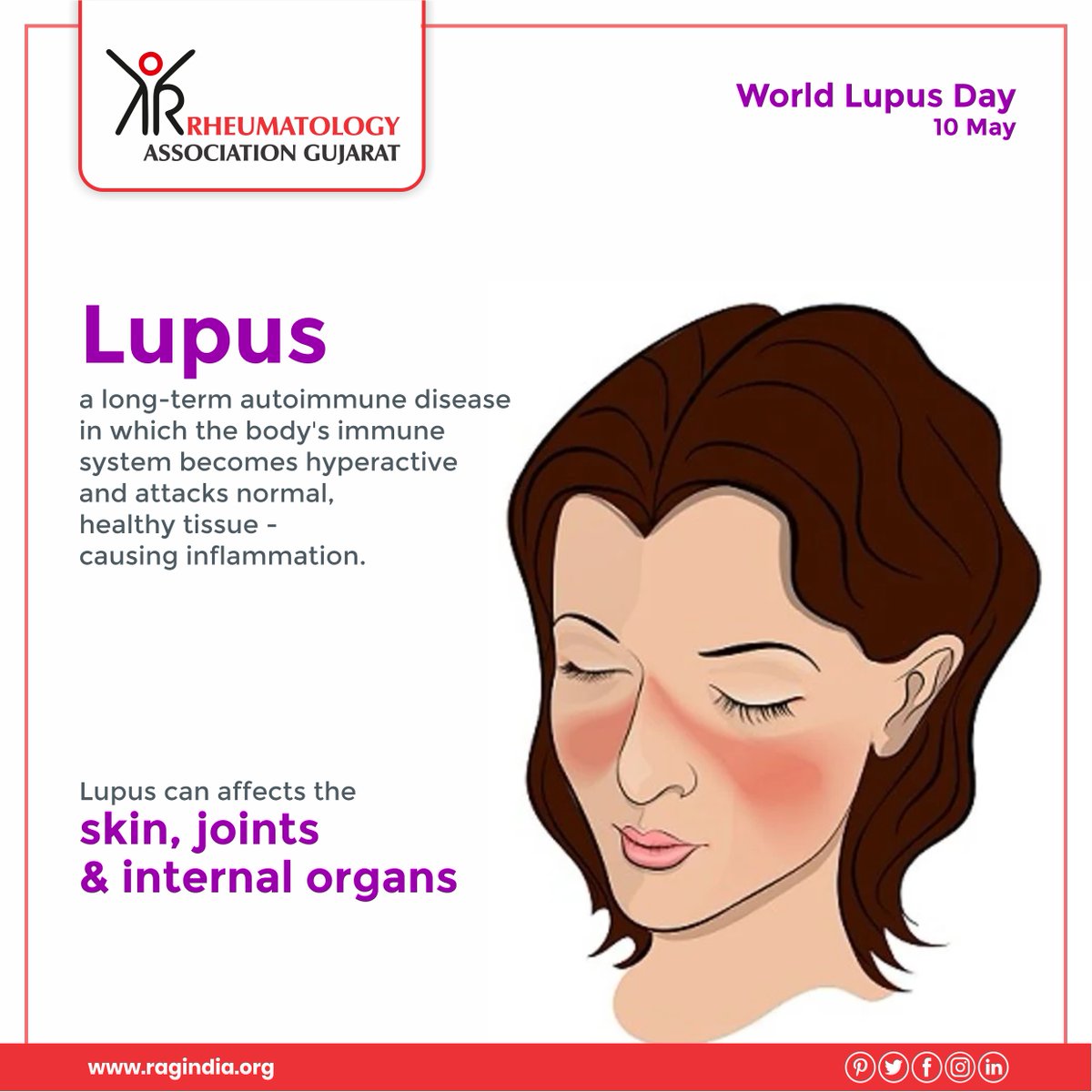 raggujarat's tweet photo. Did you know? #Lupus is a long-term chronic disease that can cause pain and #inflammation in any part of the body. 

#WorldLupusDay #RAG #Rheumatology #Arthritis #JointPain https://t.co/XtE7j0pIdr