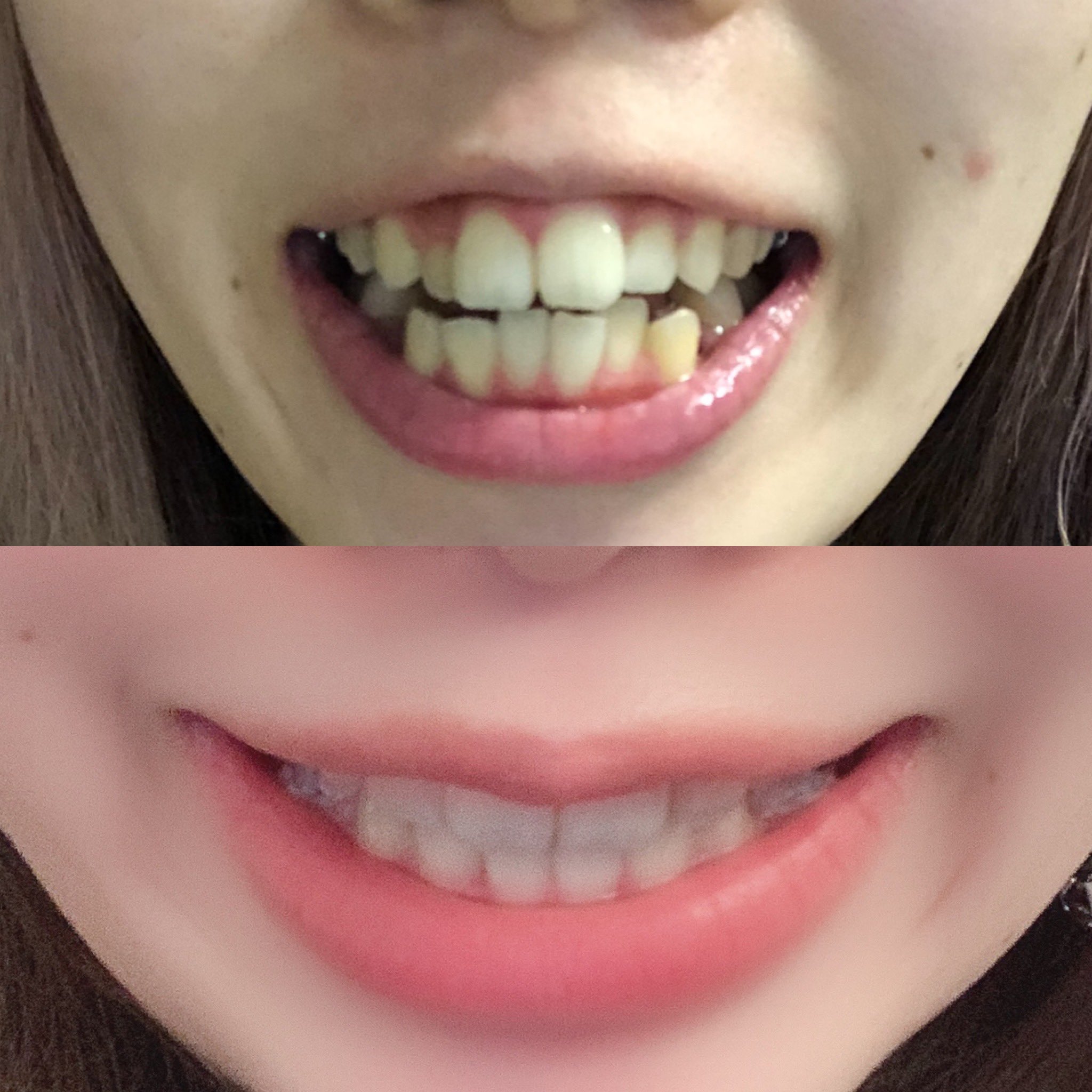 歯 列 矯正 どれくらい で 変化