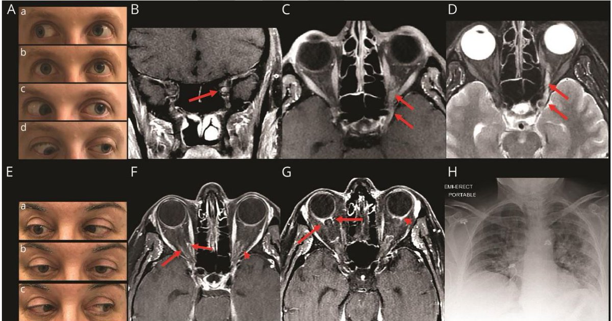 AANmember's tweet photo. Via @GreenJournal: #COVID19 presenting with ophthalmoparesis from cranial nerve palsy. https://t.co/fPbpVOOzpa #Neurology https://t.co/I3hXmz59xL