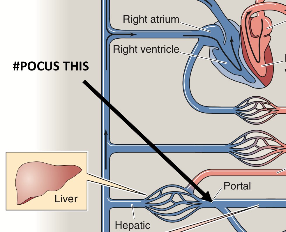 Enter the Portal Vein. Portal circulation allows us to interrogate flow in an easily scannable pre-capilary vein. Portal Vein Doppler is easy. Here is a video from  @ThinkingCC on how to do it:  https://thinkingcriticalcare.com/2020/02/28/a-vexus-mini-tutorial-foamed-pocus/ (13/17)