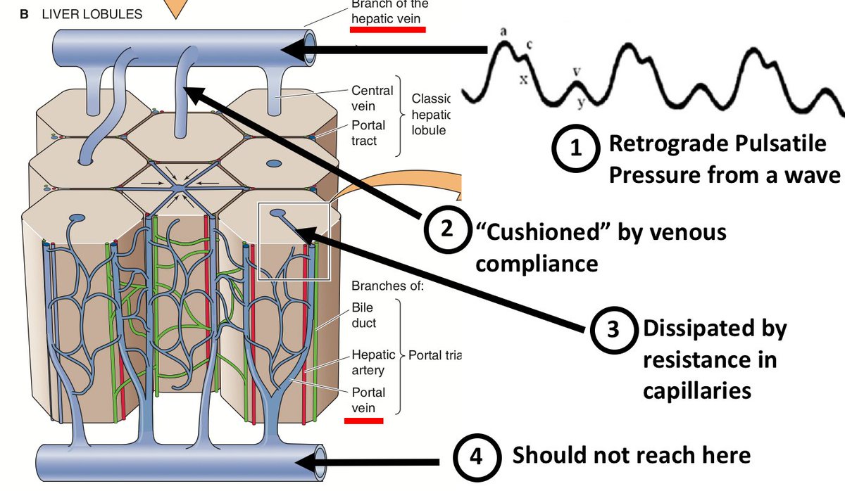 Enter the Portal Vein. Portal circulation allows us to interrogate flow in an easily scannable pre-capilary vein. Portal Vein Doppler is easy. Here is a video from  @ThinkingCC on how to do it:  https://thinkingcriticalcare.com/2020/02/28/a-vexus-mini-tutorial-foamed-pocus/ (13/17)