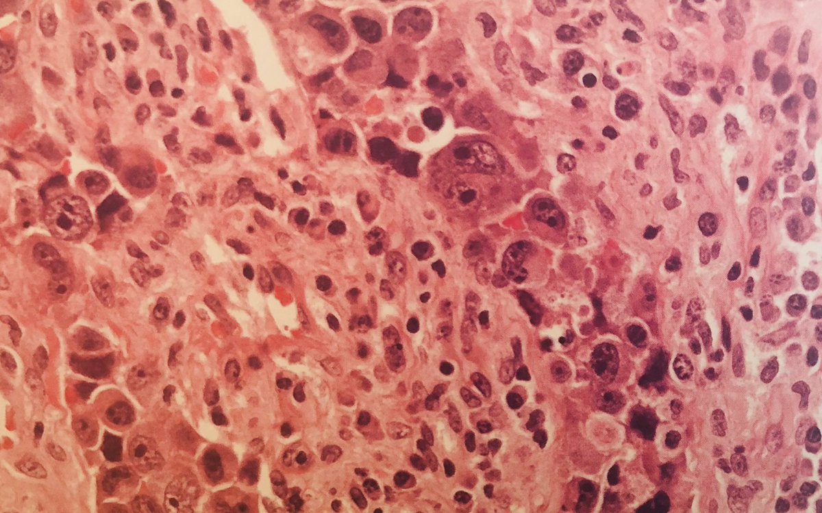 Ahmad_Hawkeye's tweet photo. Anaplastic large cell lymphoma:
High-grade lymphoma in children & young adults
Nodal disease
Anaplastic cytology
ALK expression (good prognosis)
CD30 expression
Marrow involvement 10-30% cases
t(2;5) NPM-ALK translocation
Clonal TCR rearrangement 90% cases
#hemepath #pathboards https://t.co/ydewHvo4Y5