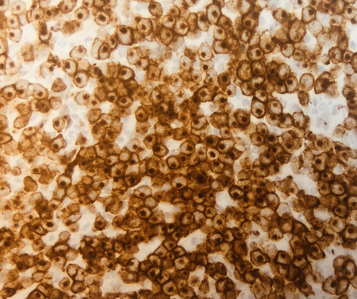 Ahmad_Hawkeye's tweet photo. Anaplastic large cell lymphoma:
High-grade lymphoma in children & young adults
Nodal disease
Anaplastic cytology
ALK expression (good prognosis)
CD30 expression
Marrow involvement 10-30% cases
t(2;5) NPM-ALK translocation
Clonal TCR rearrangement 90% cases
#hemepath #pathboards https://t.co/ydewHvo4Y5
