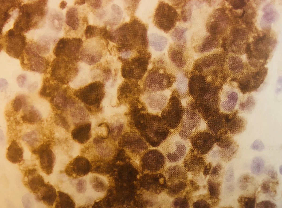 Ahmad_Hawkeye's tweet photo. Anaplastic large cell lymphoma:
High-grade lymphoma in children & young adults
Nodal disease
Anaplastic cytology
ALK expression (good prognosis)
CD30 expression
Marrow involvement 10-30% cases
t(2;5) NPM-ALK translocation
Clonal TCR rearrangement 90% cases
#hemepath #pathboards https://t.co/ydewHvo4Y5