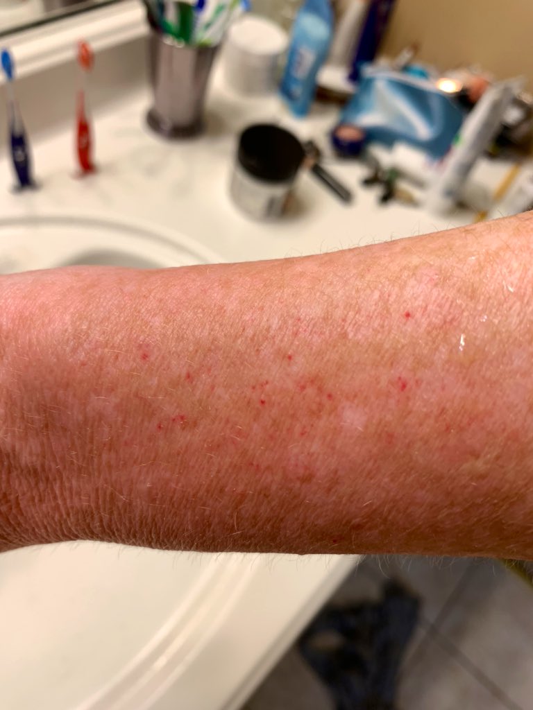 Benadryl is awesome, by the way. Most of the swelling is down and the hives are gone. I have weird blood blisters on my arms now though. But they don’t hurt anymore.