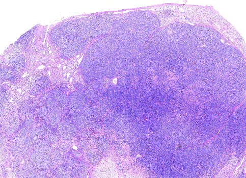 YoussefK_MD's tweet photo. 📘 Juvenile Granulosa Cell Tumor: 
➡️5% of ovarian tumors in children, 80% before age 20
➡️Micro: Diffuse to macrofollicular pattern, primitive-appearing granulosa cells with thecal component
➡️No Nuclear grooves or Call-Exner bodies
➡️IHC: Pos for Inhibin, calretinin, CD99, WT1 https://t.co/UWKKHByikI