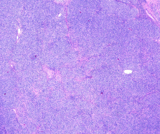 YoussefK_MD's tweet photo. 📘 Juvenile Granulosa Cell Tumor: 
➡️5% of ovarian tumors in children, 80% before age 20
➡️Micro: Diffuse to macrofollicular pattern, primitive-appearing granulosa cells with thecal component
➡️No Nuclear grooves or Call-Exner bodies
➡️IHC: Pos for Inhibin, calretinin, CD99, WT1 https://t.co/UWKKHByikI