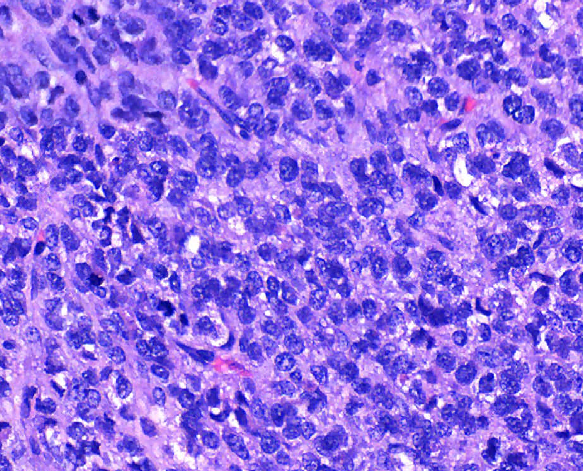 YoussefK_MD's tweet photo. 📘 Juvenile Granulosa Cell Tumor: 
➡️5% of ovarian tumors in children, 80% before age 20
➡️Micro: Diffuse to macrofollicular pattern, primitive-appearing granulosa cells with thecal component
➡️No Nuclear grooves or Call-Exner bodies
➡️IHC: Pos for Inhibin, calretinin, CD99, WT1 https://t.co/UWKKHByikI