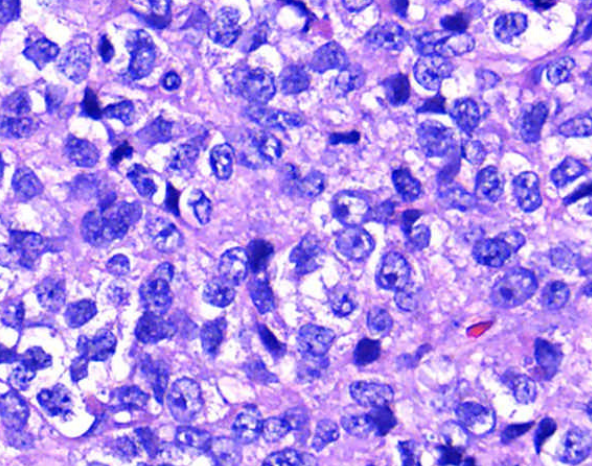 YoussefK_MD's tweet photo. 📘 Juvenile Granulosa Cell Tumor: 
➡️5% of ovarian tumors in children, 80% before age 20
➡️Micro: Diffuse to macrofollicular pattern, primitive-appearing granulosa cells with thecal component
➡️No Nuclear grooves or Call-Exner bodies
➡️IHC: Pos for Inhibin, calretinin, CD99, WT1 https://t.co/UWKKHByikI