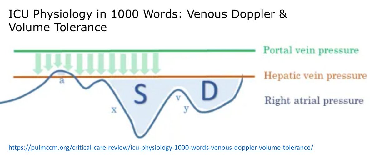 Normal portal vein flow is non pulsatile (monophasic). This in stark contrast with hepatic vein flow which basically reflects CVP pressure waveforms (pulsatile pressure in HV is not dissipated by capillary resistance, though vein and atrial compliance may "cushion" it) (14/17)