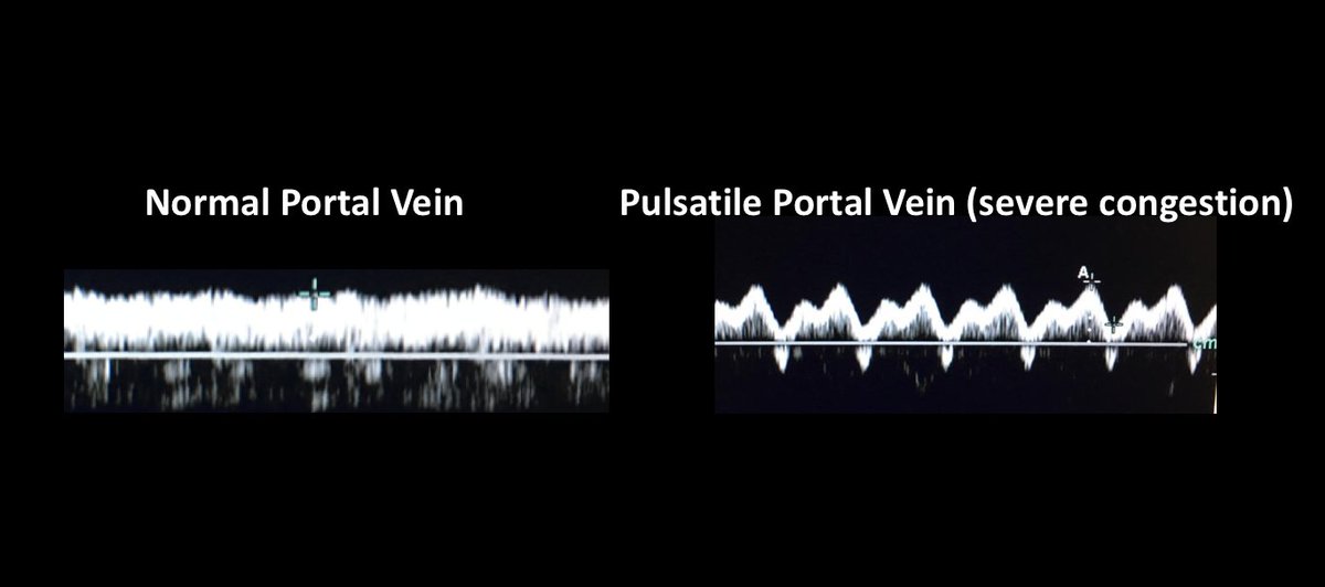 Normal portal vein flow is non pulsatile (monophasic). This in stark contrast with hepatic vein flow which basically reflects CVP pressure waveforms (pulsatile pressure in HV is not dissipated by capillary resistance, though vein and atrial compliance may "cushion" it) (14/17)