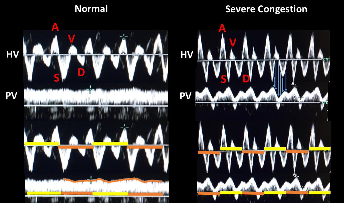 Normal portal vein flow is non pulsatile (monophasic). This in stark contrast with hepatic vein flow which basically reflects CVP pressure waveforms (pulsatile pressure in HV is not dissipated by capillary resistance, though vein and atrial compliance may "cushion" it) (14/17)