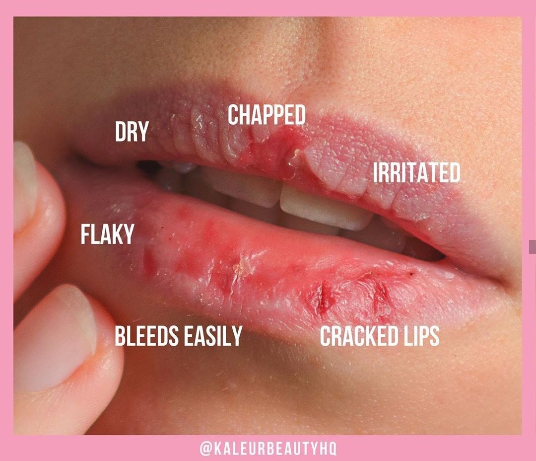Chapped Bloody Lips