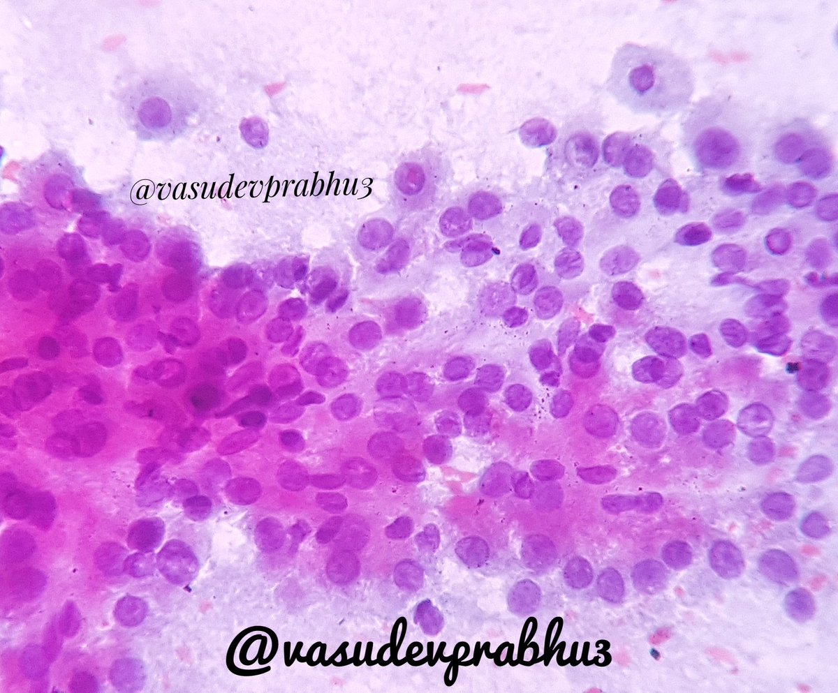 As pretty as it can get...
FNAC of #aciniccellcarcinoma salivary gland
🔬papillary architecture, bunch of grapea
🔬Oncocytoid cells with Dense Granular cytoplasm. Note the brilliant pink granules
🔬Prominent nucleoli
#cytopathology #salivaryglandpath #headandneckpath #pathboards