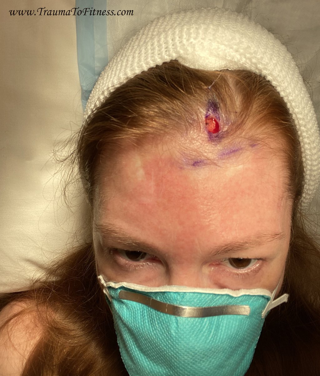 PasonActress's tweet photo. #PasonActress #TraumaToFitness #MOHsSurgery #SkinCancerSurgery #SkinCancerSurgeryOnScalp #Redheads #BasalCellSkinCancer #COVID-19 #Writer #Producer #MotivationalSpeaker #PublicSpeaker #Consultant #Health #RegionalAnesthesia #NumbingShot #PreppingForStitches #Health #Cancer https://t.co/auT8pvgQDH