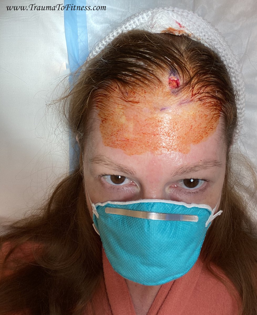 PasonActress's tweet photo. #PasonActress #TraumaToFitness #MOHsSurgery #SkinCancerSurgery #SkinCancerSurgeryOnScalp #Redheads #BasalCellSkinCancer #COVID-19 #Writer #Producer #MotivationalSpeaker #PublicSpeaker #Consultant #Health #RegionalAnesthesia #NumbingShot #PreppingForStitches #Health #Cancer https://t.co/auT8pvgQDH