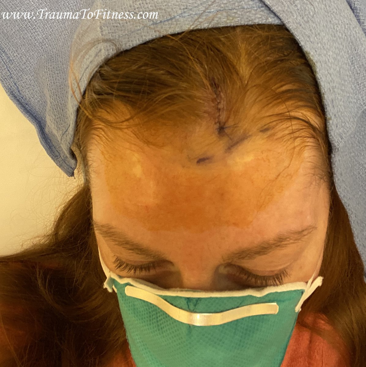 PasonActress's tweet photo. #MOHs #SkinCancerSurgery on #scalp &amp; #FrozenPreCancer #Lip. 5-5-20 #PasonActress #TraumaToFitness #COVID_19 #MOHs #MOHsSurgery #Redheads #SkinCancer #BasalCellSkinCancer #Writer #Producer #Host #MotivationalSpeaker #PublicSpeaker #Consultant #Health #BandagedUp #UCLAHealth https://t.co/XYw2nLOQtQ