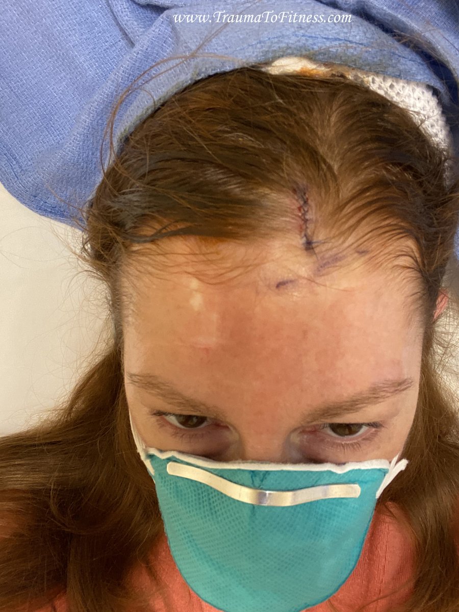 PasonActress's tweet photo. #MOHs #SkinCancerSurgery on #scalp &amp; #FrozenPreCancer #Lip. 5-5-20 #PasonActress #TraumaToFitness #COVID_19 #MOHs #MOHsSurgery #Redheads #SkinCancer #BasalCellSkinCancer #Writer #Producer #Host #MotivationalSpeaker #PublicSpeaker #Consultant #Health #BandagedUp #UCLAHealth https://t.co/XYw2nLOQtQ