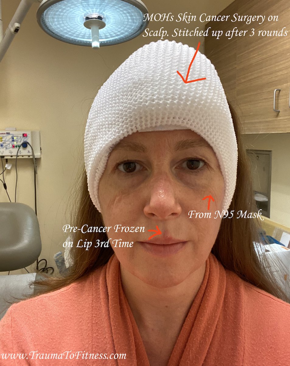 PasonActress's tweet photo. #MOHs #SkinCancerSurgery on #scalp &amp; #FrozenPreCancer #Lip. 5-5-20 #PasonActress #TraumaToFitness #COVID_19 #MOHs #MOHsSurgery #Redheads #SkinCancer #BasalCellSkinCancer #Writer #Producer #Host #MotivationalSpeaker #PublicSpeaker #Consultant #Health #BandagedUp #UCLAHealth https://t.co/XYw2nLOQtQ