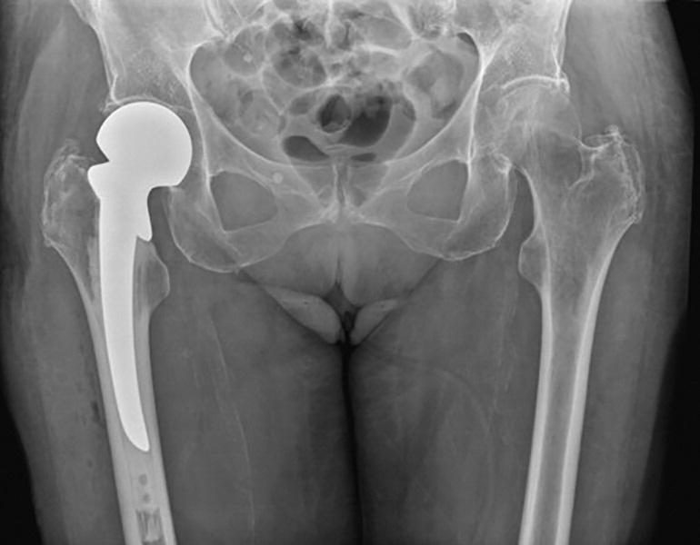 cursocot's tweet photo. Not always the new is the best: A cemented Thompson hemiarthroplasty may provide similar health-related quality of life compared with modern implants for patients with a displaced intracapsular fracture of the hip. And it is cheaper! https://t.co/kEbNZGgYlL https://t.co/CeKzyl9Gnm