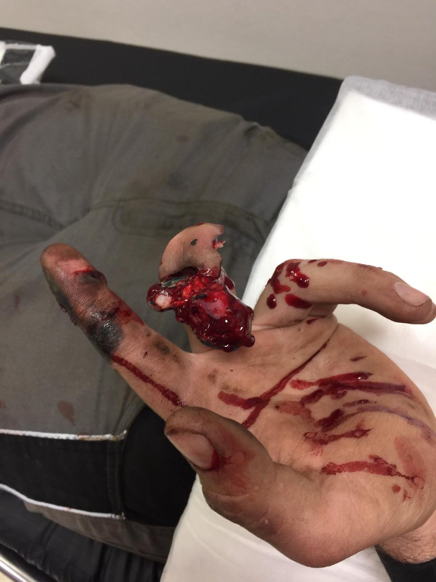 jamiehamilton44's tweet photo. @winkerwatson1 Welcome to the gang @winkerwatson1. I cut a bit off one of mine last year. 😬😬😬😬 https://t.co/KfOxyiUPHu
