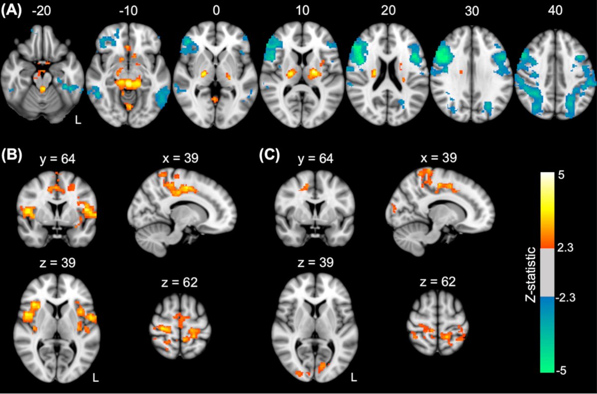 siti yaakub (@sitiny0) on Twitter photo Our new paper shows network changes related to the EEG alpha rhythm as potential #endophenotypes for temporal lobe #epilepsy
onlinelibrary.wiley.com/doi/full/10.10…
#neuroimaging #EEG #EEGfMRI
<a href="/KingsIoPPN/">Institute of Psychiatry, Psychology & Neuroscience</a> <a href="/kingshealth/">King's Health Partners</a> <a href="/KingsImaging/">Biomedical Engineering & Imaging Sciences</a> Our new paper shows network changes related to the EEG alpha rhythm as potential #endophenotypes for temporal lobe #epilepsy
onlinelibrary.wiley.com/doi/full/10.10…
#neuroimaging #EEG #EEGfMRI
<a href="/KingsIoPPN/">Institute of Psychiatry, Psychology & Neuroscience</a> <a href="/kingshealth/">King's Health Partners</a> <a href="/KingsImaging/">Biomedical Engineering & Imaging Sciences</a>