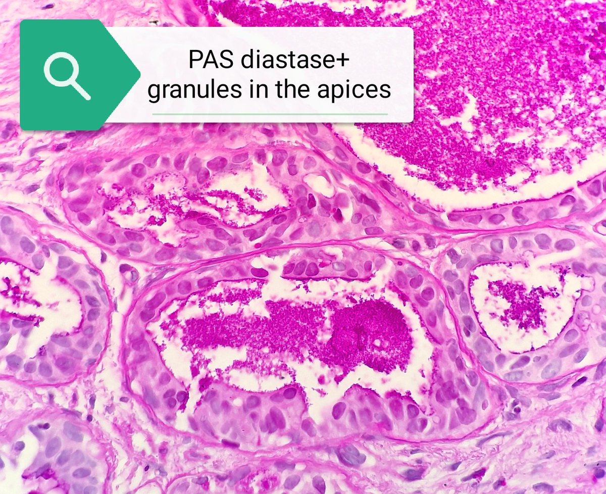 dr_MPrieto's tweet photo. #caseoftheday 46 yo👩🏻‍🦱 with reddish lesions in vulva 🔬 Hidradenoma papilliferum
🔹Vulval &amp; perianal regions
🔹Nodule <1cm middle age 👩🏻‍🦱
🔹Partly cystic
🔹Ca in situ assoc
🔹Arborizing trabecular pattern
🔹Columnar cells with nipple-like cytoplasmic projections
#dermpath #gynpath https://t.co/p4sruGN3uc