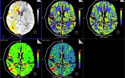 UCL Brain Sciences (@uclbrainscience) on Twitter photo In case you missed it: Clinical observations of COVID-19 patients, who went on to have a stroke, suggest coronavirus may cause clots within blood vessels in the brain, finds a team from <a href="/UCLIoN/">UCL Queen Square Institute of Neurology</a> & <a href="/uclh/">UCLH</a> (National Hospital for Neurology and Neurosurgery): bit.ly/35Q2hW6 In case you missed it: Clinical observations of COVID-19 patients, who went on to have a stroke, suggest coronavirus may cause clots within blood vessels in the brain, finds a team from <a href="/UCLIoN/">UCL Queen Square Institute of Neurology</a> & <a href="/uclh/">UCLH</a> (National Hospital for Neurology and Neurosurgery): bit.ly/35Q2hW6