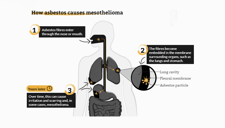 Is Stage 4 Non Small Cell Lung Cancer Curable