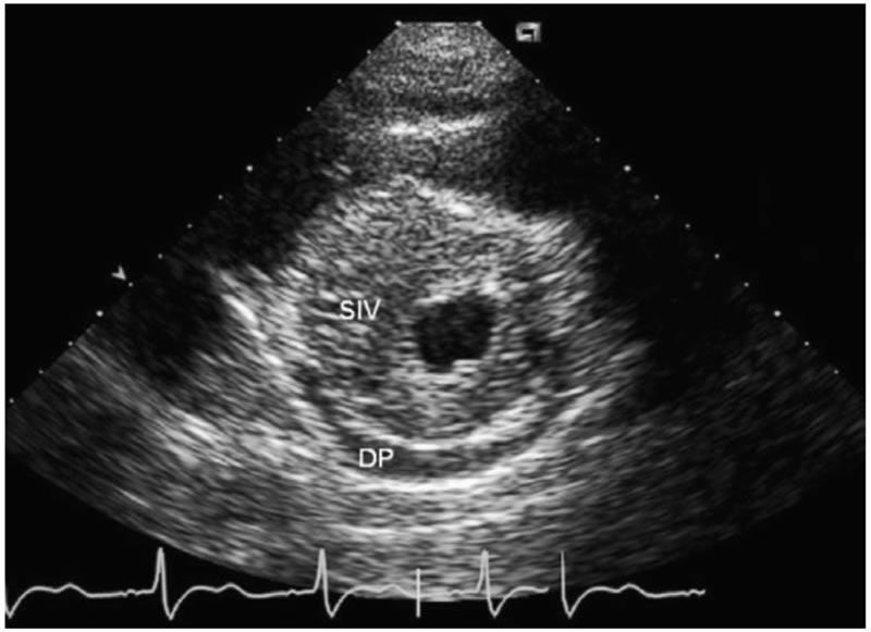 ¿Cómo es una miocardiopatía hipertrófica? ¿Qué tipos existen? buff.ly/2yDwY4O
Repaso del capítulo "Miocardiopatías" de nuestra Biblioteca de Preguntas Básicas de Imagen Cardíaca