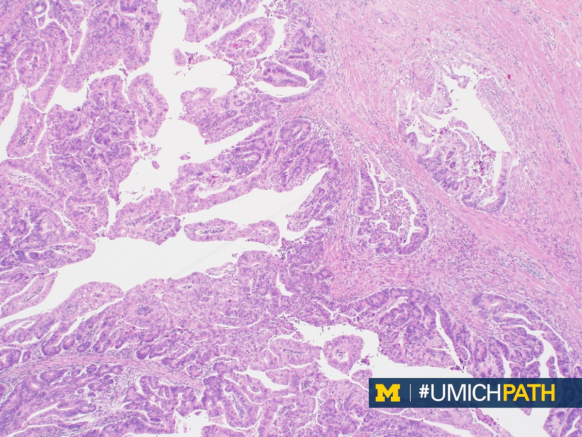 A new article from #UMichPath faculty Jiaqi Shi, MD, PhD, discusses intraductal papillary neoplasm of the bile duct and its relationship to radiology-pathology.

Read the full publication here: clinicalimaging.org/article/S0899-…