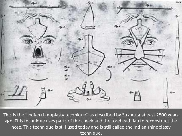 Maharshi  Sushruta's contribution in the field of Plastic Surgery can be enumerated as follows.- Classification of mutilated ear lobe defects and techniques for repair of torn ear lobes (15 different types of otoplasties)- Cheek flap for reconstruction of absent ear lobe.