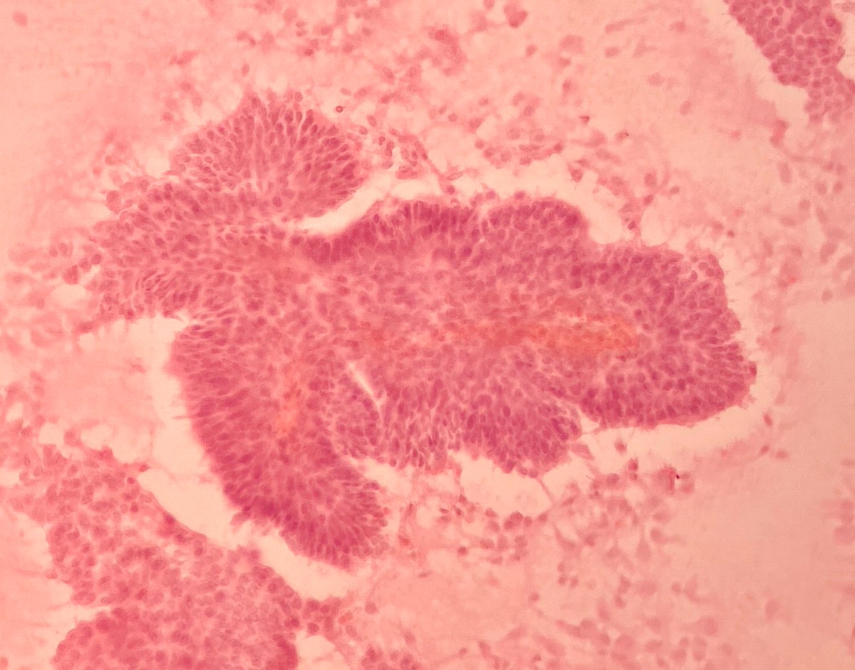 martinwpath's tweet photo. An adult female presented with a 4th ventricle mass and hydrocephalus. A biopsy was done with IOC (Pic 1/2). Sections showed a neoplasm with papillary architecture and fibrovascular cores lined by flat surface epithelium (Pic 3/4). https://t.co/SCi9JIngqe
